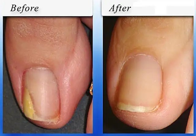 ongle fongique ongle fongique