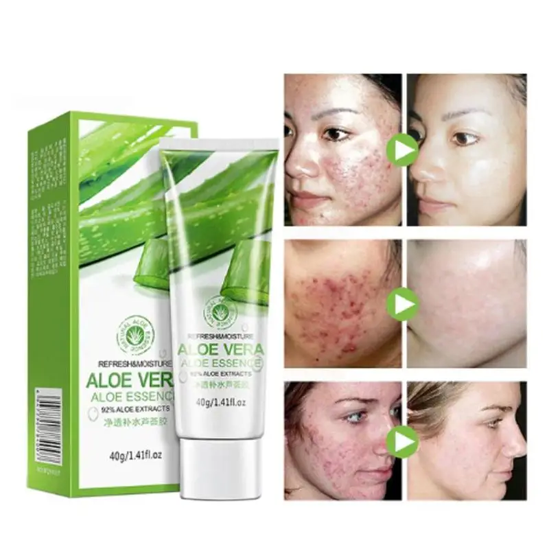 aloe vera viso acne