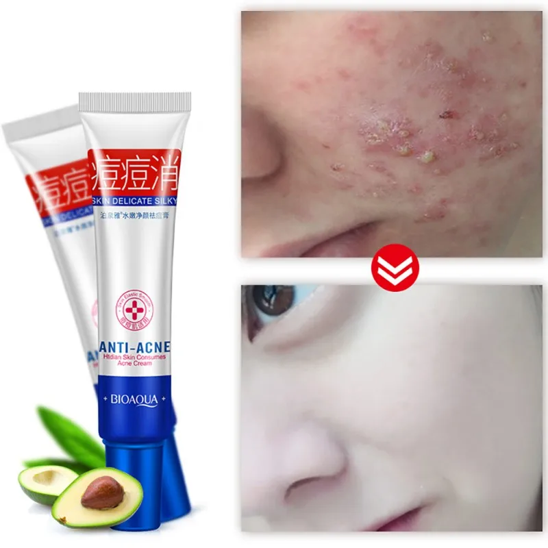 Anti Acne Cream Oil Control Shrink Pores Acne Scar Remove Face Care