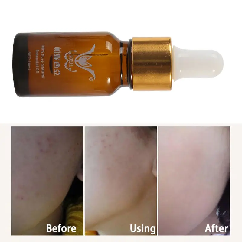 

Newest Women Makeup Essence Skin Repair Full-body Whitening Essential oils Remove Dead Skin Goose Bumps Pimples Folliculitis