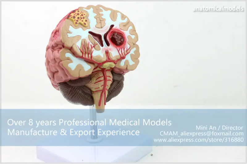 BRAIN10 CMAM model brain diseases anatomical model 4