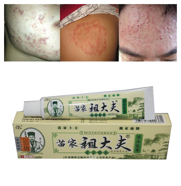 1Pcs Chinese Ointment for Eczema Tinea Dermatitis Tinea Corporis ...