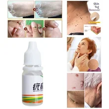 Новое средство для удаления кожных ярлыков, медицинское средство для удаления кожных ярлыков, средство для удаления бородавок WH998