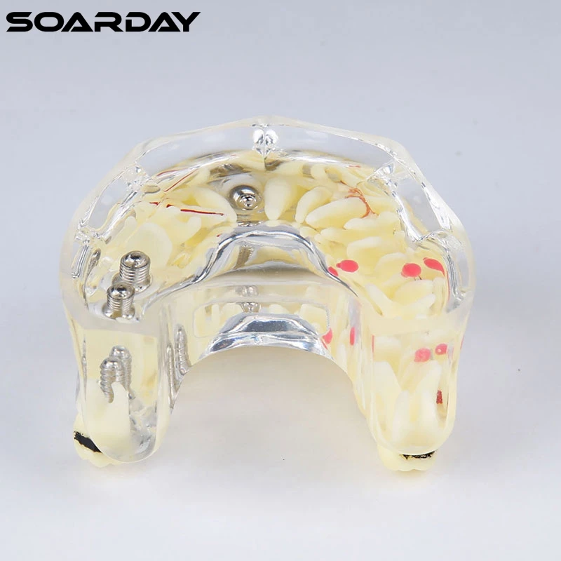 Implant-model-with-bridge-and-caries-2