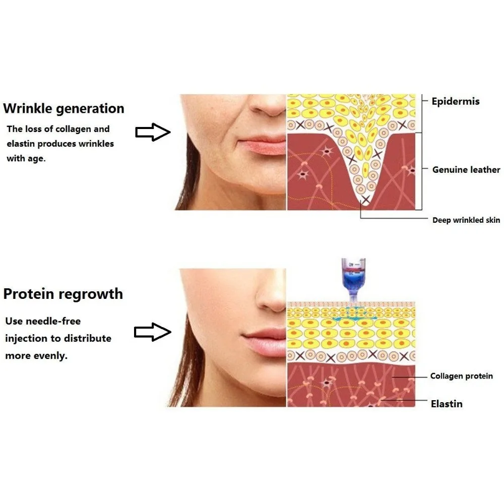 Мезотерапия безинъекционная красота пистолет без необходимости распыления Мезотерапия удаление морщин гиалуроновая шприц-ручка+ 5 ампул головы наборы