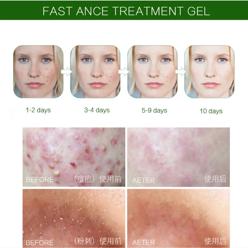 

Tea Tree Medicated Acne Gel Kill Bacteria Anti Infection Acne Scar Treatment Cream Facial Acne Care 100% Pure 25g
