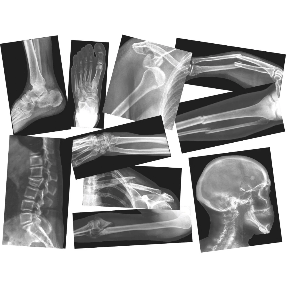 Roylco 1015092 Broken Bones X-Rays With Teacher Guide Set - 15