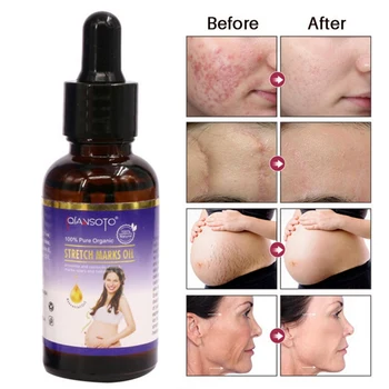 

Repair Stretch Mark Cream Body Stretch Marks Remover Body Essential Oil Skin Serum Treatment
