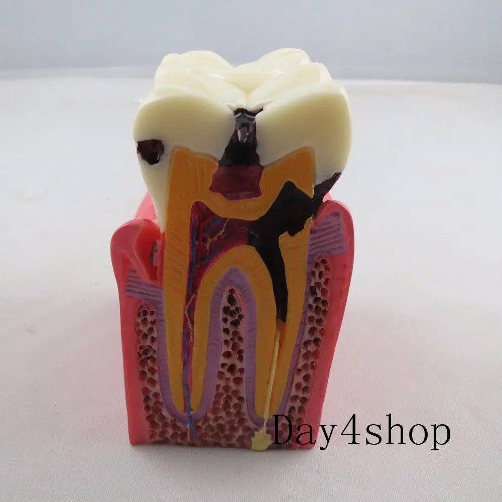 

NEW 1PCS 6X Denture Teeth Model Caries Comparison Model Tooth Decay Model Dentist Pathologies For Medical Science Teaching