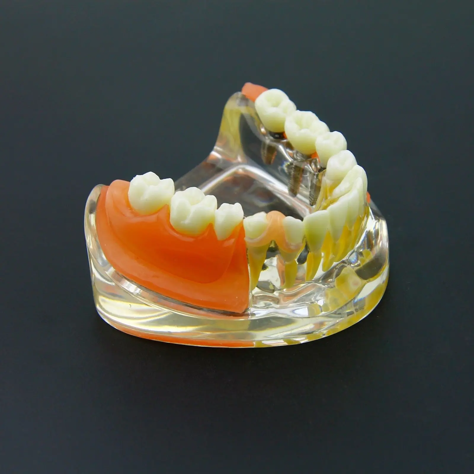 

Dental Implant Restoration Teeth Model Removable Bridge Denture Demo #6006