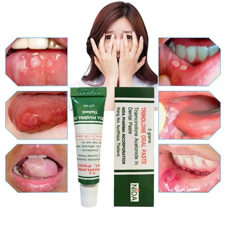 

Oral Ulcer Treatment Cream Ointment Tongue Pain Ulceration Paste Plaster Inflammation Remedy Removal Herbal Antibacterial Gel