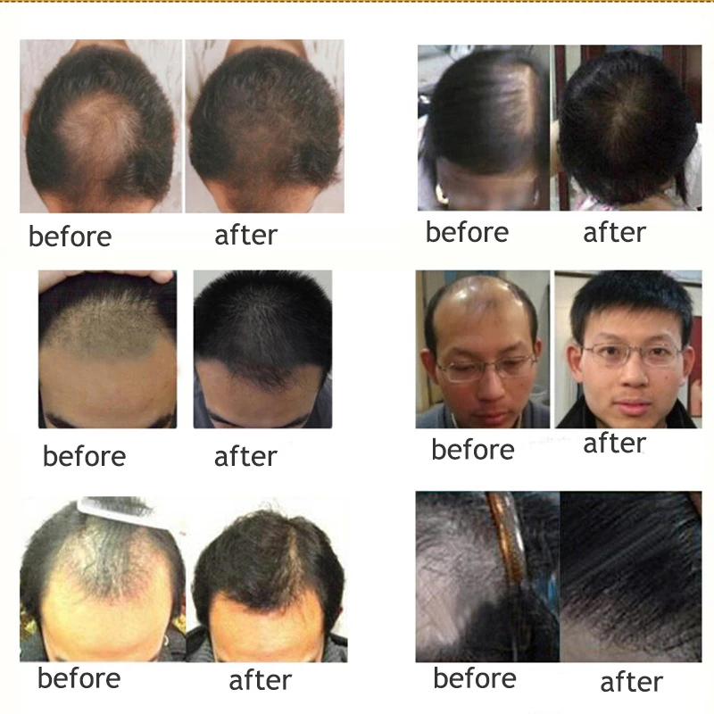 Queda de Cabelo Produtos de Cabelo Líquido o Crescimento do Cabelo Rápida para Mulheres dos Homens Ciytan Médica Essência Anti Denso Sunburst Crescer Tratamento Alopecia 10 Do Cabelo Sunburst Crescer Tratamento alopecia Rápida Para Mulheres Dos Homens