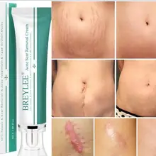 30 г брендовый крем для удаления шрамов, уход за кожей лица от прыщей, удаление растяжек, лечение от прыщей, отбеливание, увлажняющий крем