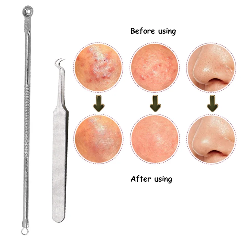 

Vopregezi 2pcs=1set Acne Needle Tweezers Face Care Tool Blackhead Pimple Remover Acne Comedone Extractor Clean Face Beauty Tool