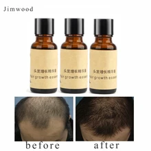 3 шт./лот рост волос от выпадения волос жидкость 20 мл/бутылка густые волосы быстрый рост Выжженных волос растут неправильный возврат алопеция