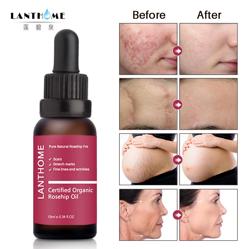 

Pure Rosehip Oil Essence Face Cream Moisturizing Acne Treatment Skin Care Repair Whitening AntiAnging Winkles Face Serum TSLM1