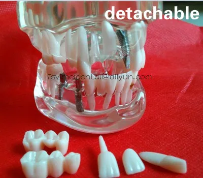 

Oral Science Education Equipment Root Canal Filling Model Dental removeable Teeth Model dental activity pathological model