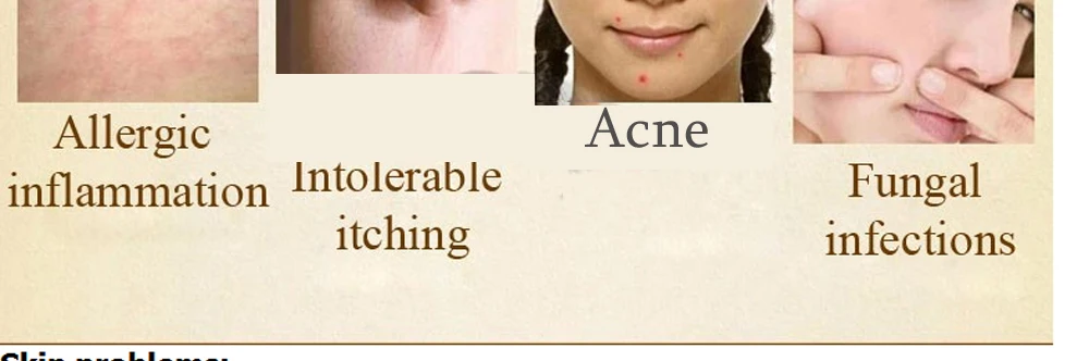 2018 Самый дешевый Hotest 85 г Шанхай серы мыло 4 условия кожи Acne Псориаз Себорея Экзема Анти Гриб Ванна здорового чистке