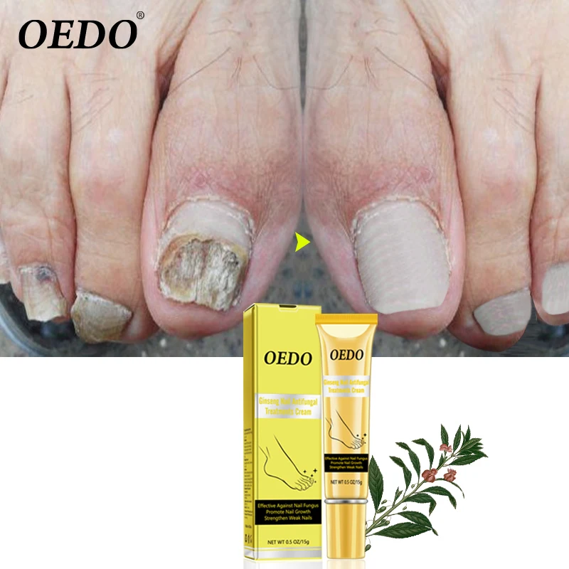 OEDO травяной женьшень противогрибковый лак для ногтей для лечения онихомикоза, онихомикоза, ног бактериальная инфекция крем для ухода за ногами