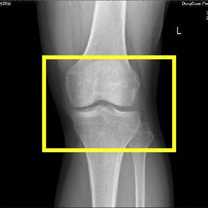 20 шт./партия наколенники Synovial патч Обезболивание коленного жидкости Гидростатический Meniscus защита коленей медицинский пластырь бесплатно