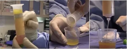 fat liquid remove