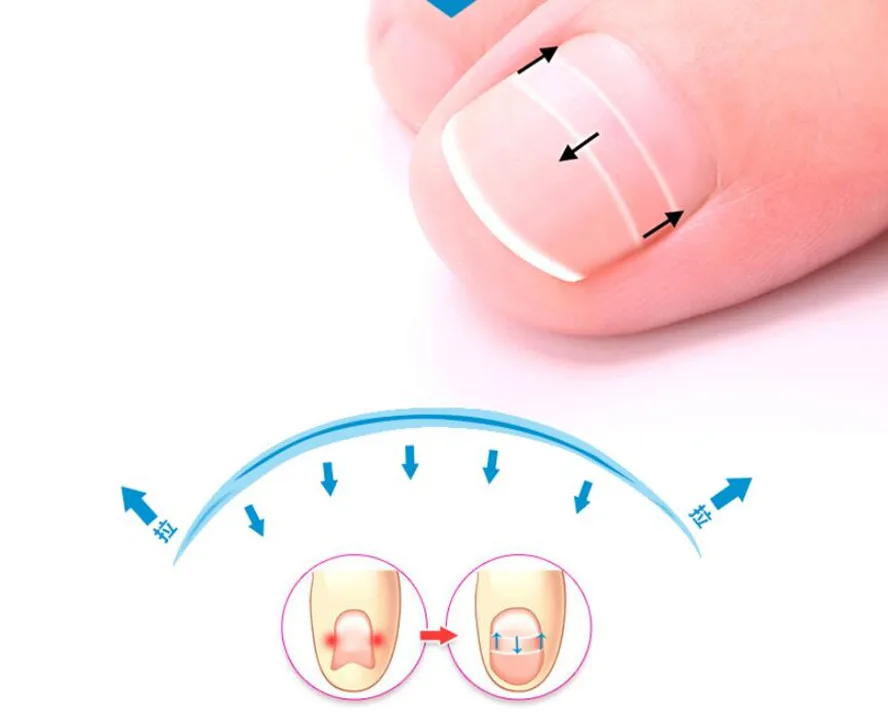 Лидер продаж 10 шт./кор. вросших ногтей коррекция носок Стикеры патч коррекция паронихии файл акроникс проволочный корректор инструмент для ухода за ногами