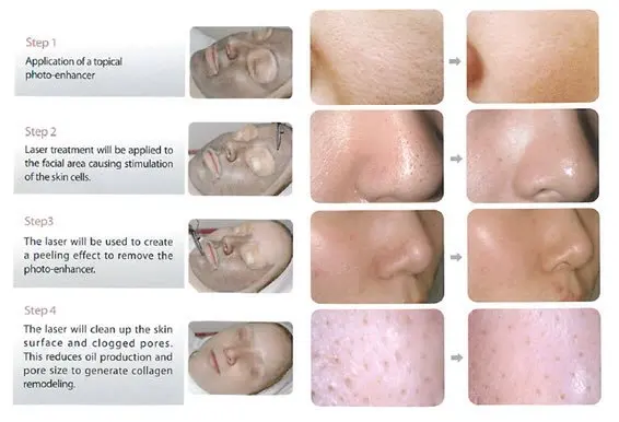 Spectra Hollywod Laser Peel In Boca Raton Fl Dermpartners