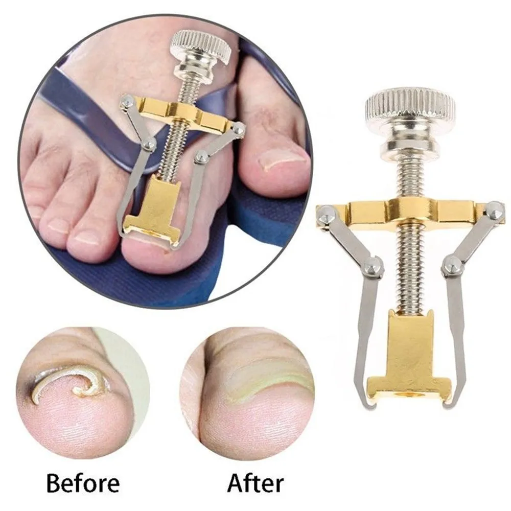 

Ingrown Toenails pedicure foot nail care tools file for feet orthotic acronyx ingrowing nail onyxis bunion corrector for toes