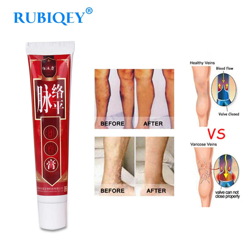 

Varicose Veins Treatment Cream Ointment Vasculitis Phlebitis Spider Veins Pain Varicosity Angiitis Remedy Removal Herbal Cream