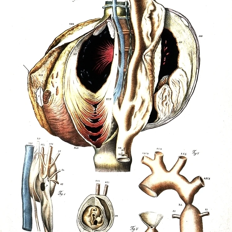 Diseased Artery  Aneurism of the Aorta Poster Print by Science Source (24 x 36)