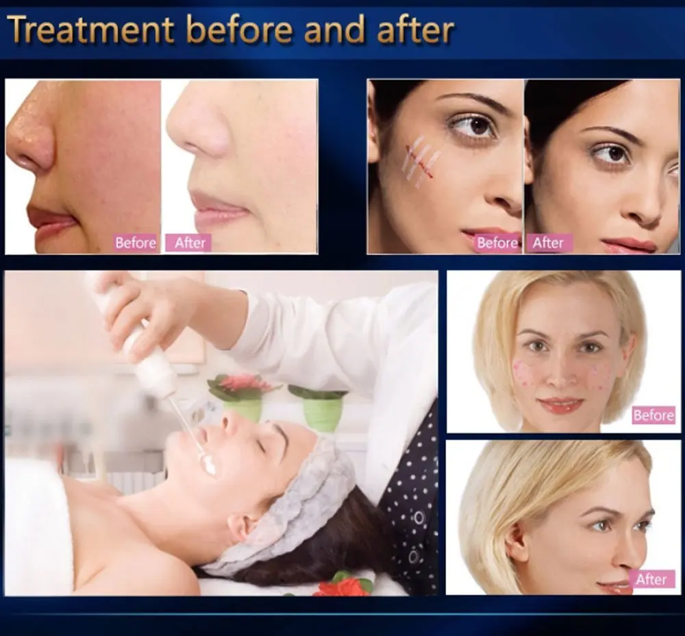 Baratos Máquina Facial portátil de alta frecuencia acné, antiinflamatorio, ajuste de la piel, arrugas, líneas finas