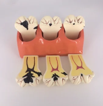 

Dental model 4 times Caries decomposition model Doctor-patient communication model