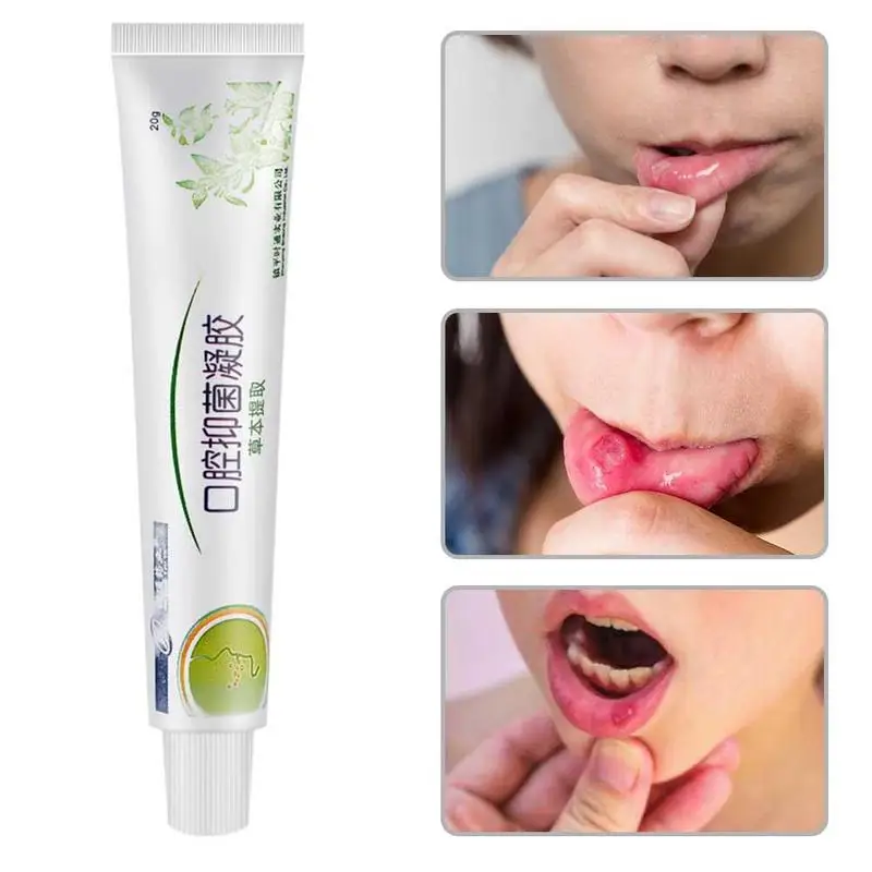 

20g Mouth Ulcer Relief Gel Natural Herbal Oral Antibacterial Cream Fast Relief From Severe Pain Irritation Within 2 Minutes