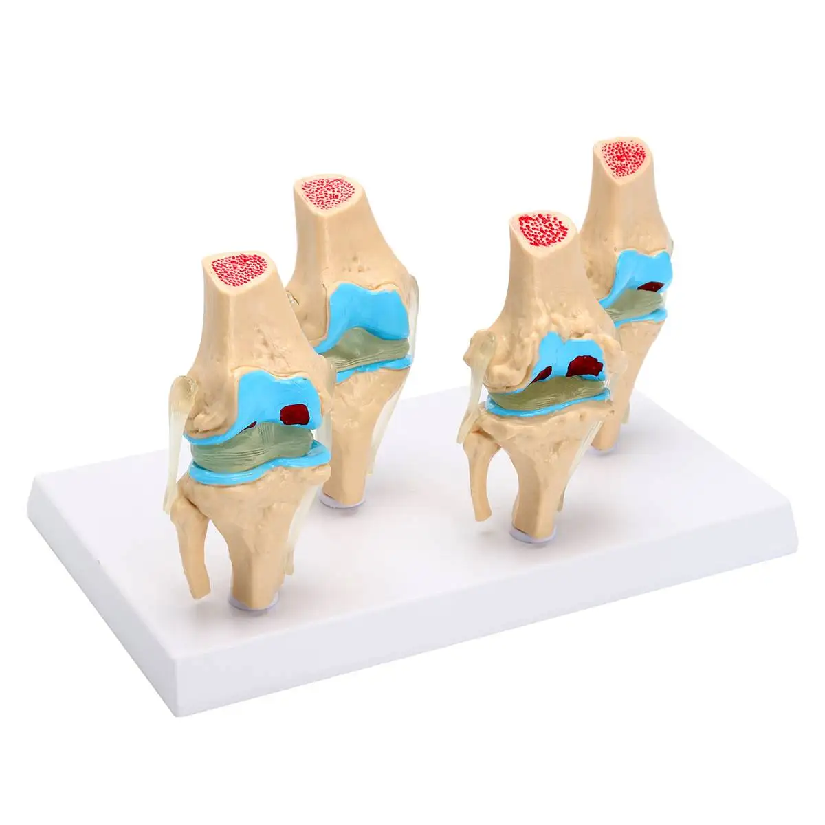 

1 Set Detachable Human Skeleton Knee Joint Anatomy Model Osteoporosis Morbid State Models Medical Science Teaching Supplies