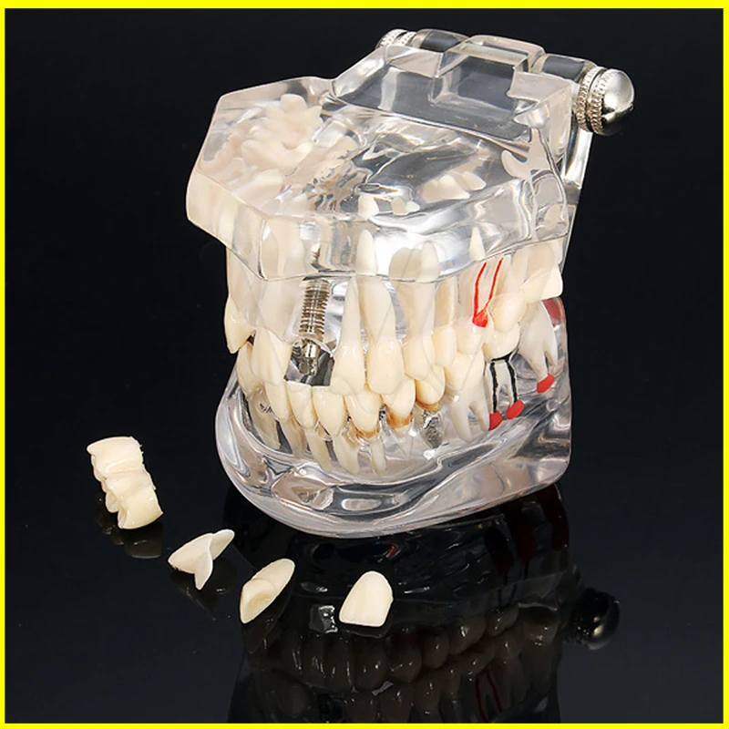 Зубной имплантат демонстрационная подставка моделирование зубов Модель зубы Съемный