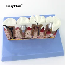 Medical Dental Model Oral Dental Disease Planting Repair Model Oral pathology Medical teaching Model traumatic pistol цена Medical Dental Model Oral Dental Disease Planting Repair Model Oral pathology Medical teaching Model traumatic pistol цены онлайн