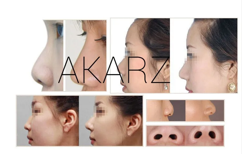 AKARZ от известного бренда, эфирные масла, увеличивающие рост носа, Ремоделирование носовой кости, уход за носом, тонкое масло для носа меньшего размера
