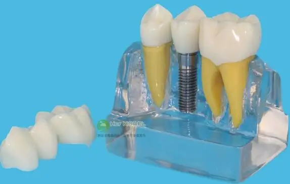 

Dentist doctor Patient communication implanted teeth Demo Model free shipping