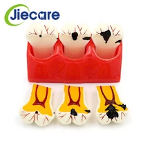 Modèle de dentisterie dentaire, 1 pièce, modèles de Caries, de désassemblage, de comparaison, de carie dentaire, modèles de carie dentaire, pathologiques pour l'enseignement médical