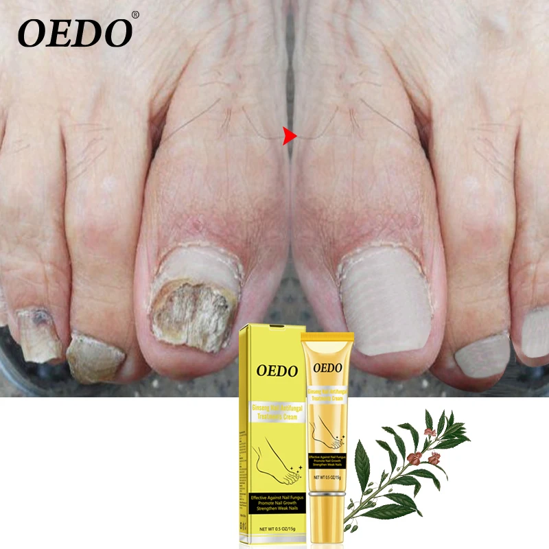 Женьшень Для ногтей антигрибковые процедуры травяной крем удаление ногтей грибок ног анти-инфекция Paronychia Onychomycosis крем для ног