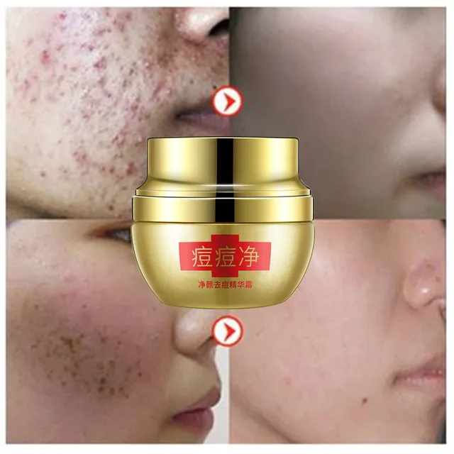 Removedor de La Espinilla del Tratamiento del acné Crema Removedor de La Espinilla del Tratamiento del acné Crema