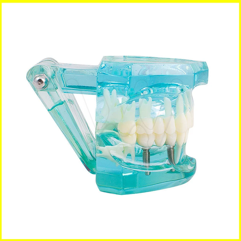 Dental Study Tooth Model Adult Pathological teaching Teeth model new denshine (5)