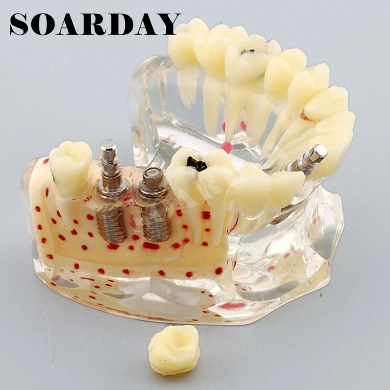 Implant Dental Model for Upper teeth Implant Spongy Bone Carious (4)