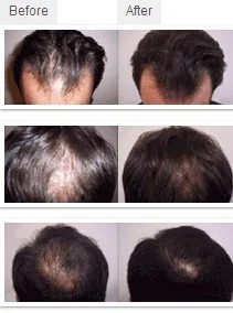 Laser Helmet Hair Growth System
