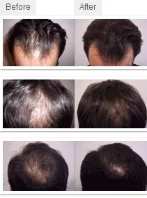 Regrowth do Cabelo do Laser Capacete com Preço de Atacado Nova Restauração Capilar Transporte da Gota 8 helmet prices