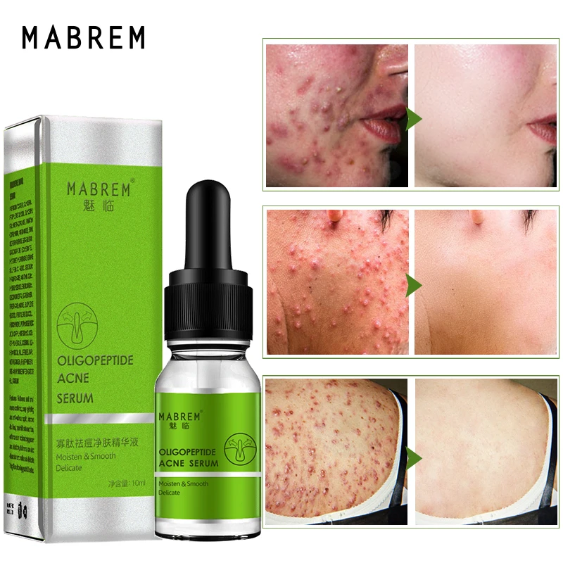 

Oligopeptide Acne Cleaning Lotion Serum Acne Treatment Cream Pore Repair Whitening Anti Anging Winkles Essence Moisturizing 10ML
