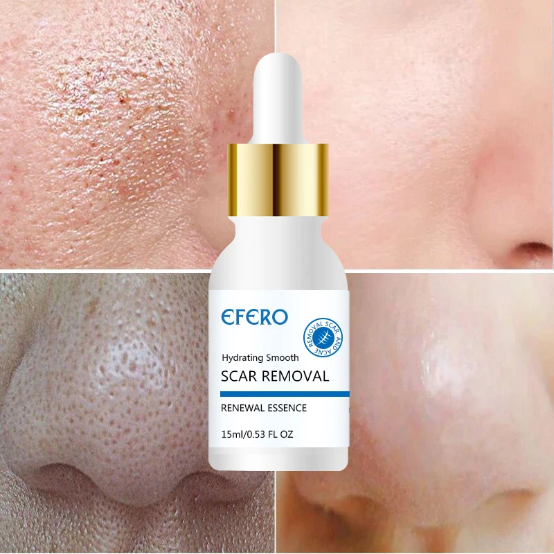 EFERO 1 Bottle Anti Acne Face Serum Skin Care Essence Moisture Whitening Cream Anti Aging Serum Acne Remover Shrink Pores