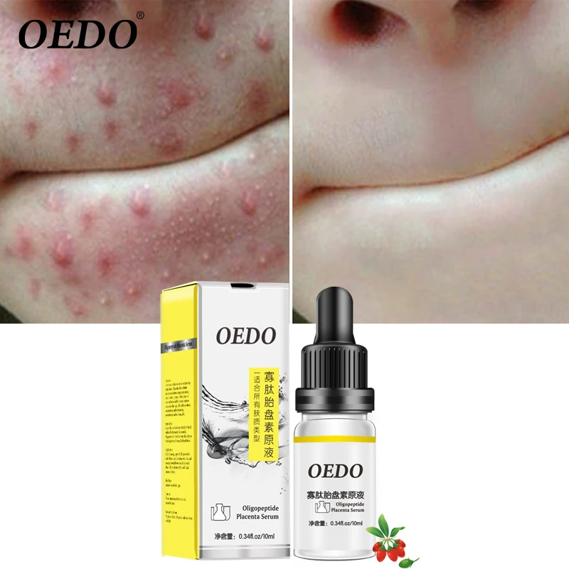 

OEDO Oligopeptide Placenta Acne Skin Rejuvenating Essence Liquid To Remove Acne Marks To Repair Facial Skin Whitening Fine Pores