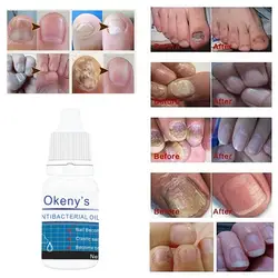 Мощное Лечение грибка для ногтей и грибка для ногтей, антибактериальное масло для удаления онихомикоза