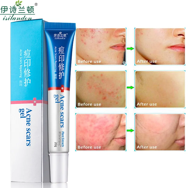 

ISILANDON Authentic Acne Treatment Cream Anti Acne Cream Scar Removal Gel Cleaning Pimple Shrink Pores For Face Skin Care 20g